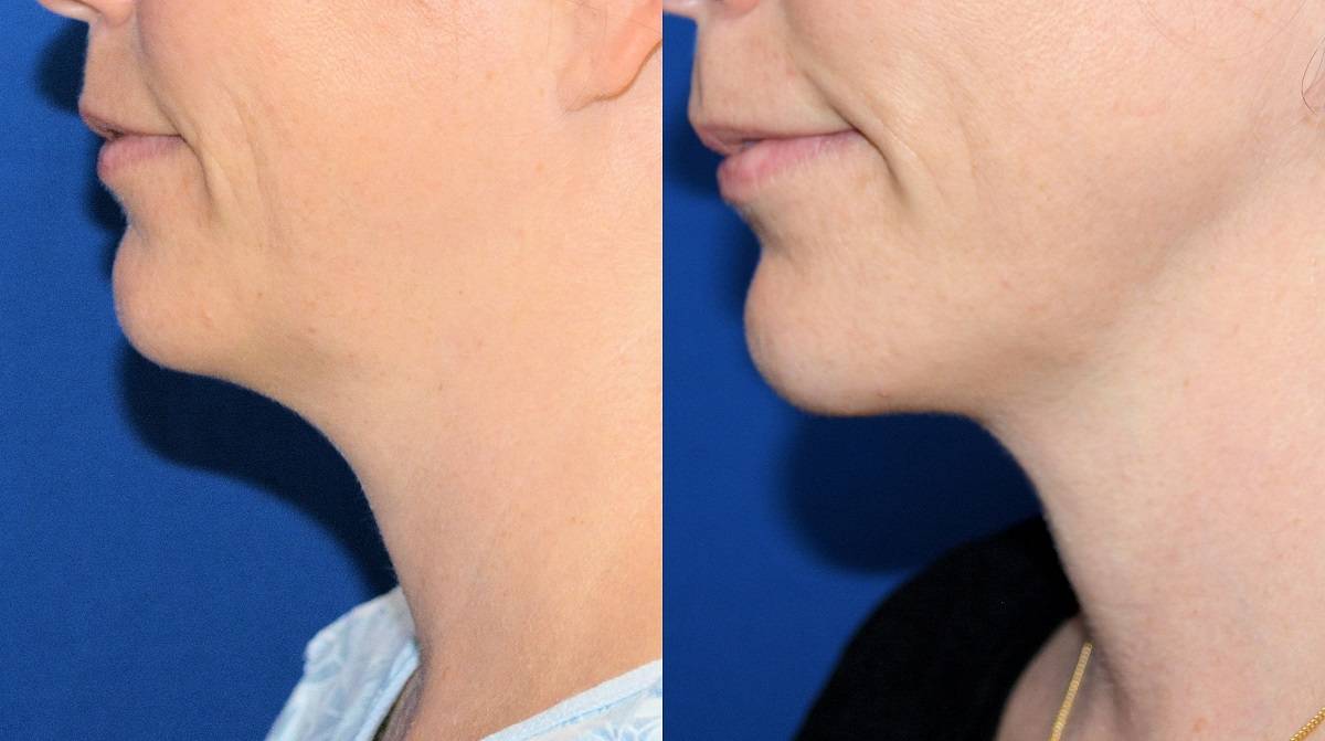 9 Dr. Marc Wetherington in Rome, GA, is the area leader in SmartLipo for the neck