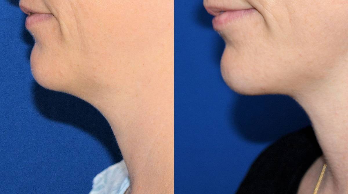 7 Dr. Marc Wetherington in Rome, GA, is the area leader in SmartLipo for the neck