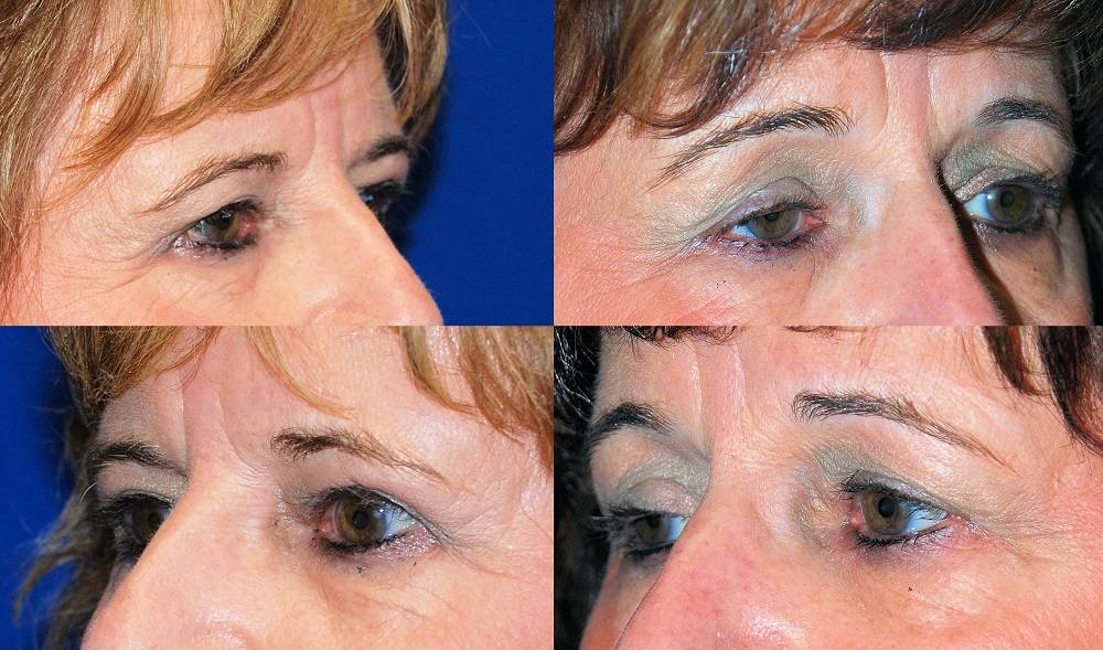 01 Dr. Marc Wetherington in Rome, GA, is the area leader in brow lifts