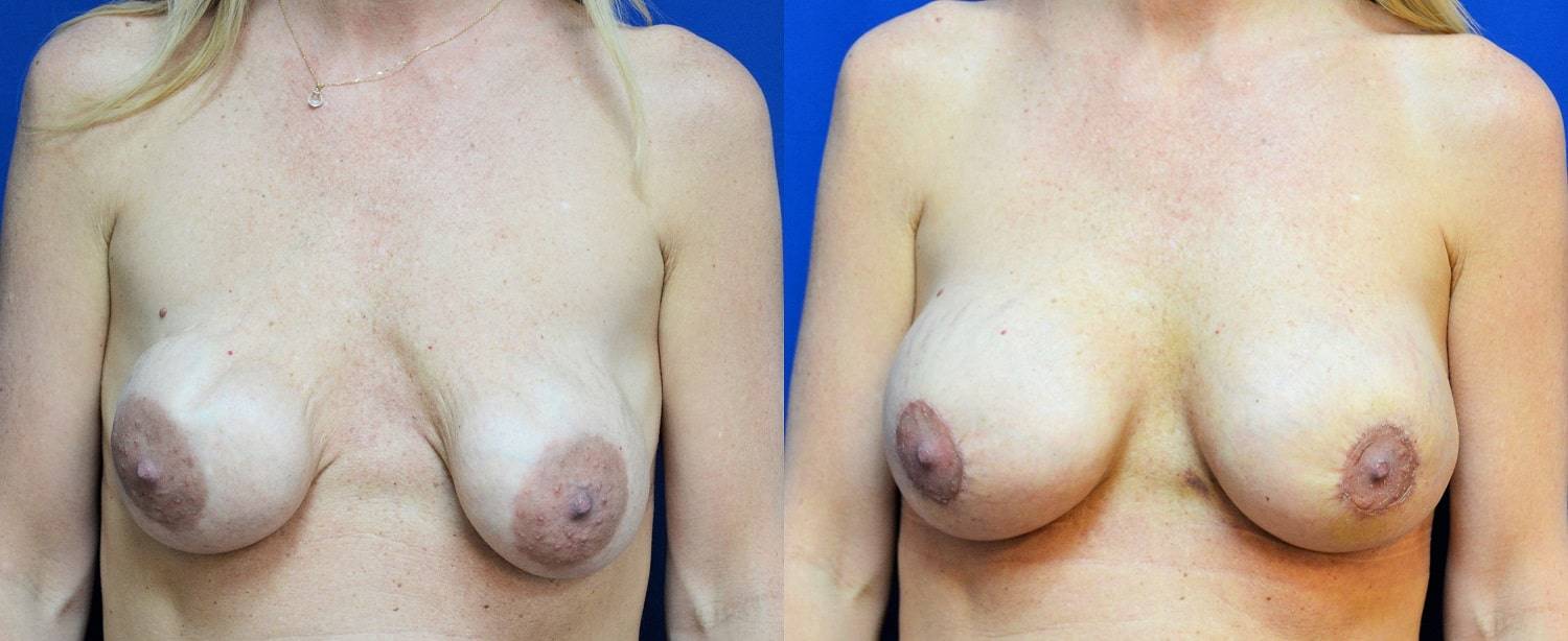 01-re-do-breast-surgery-dr-marc-wetherington-rome-ga
