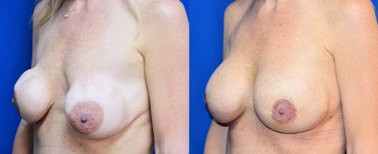 02-re-do-breast-surgery-dr-marc-wetherington-rome-ga