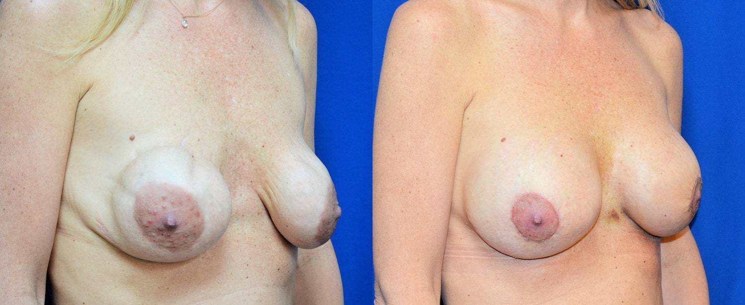 03-re-do-breast-surgery-dr-marc-wetherington-rome-ga