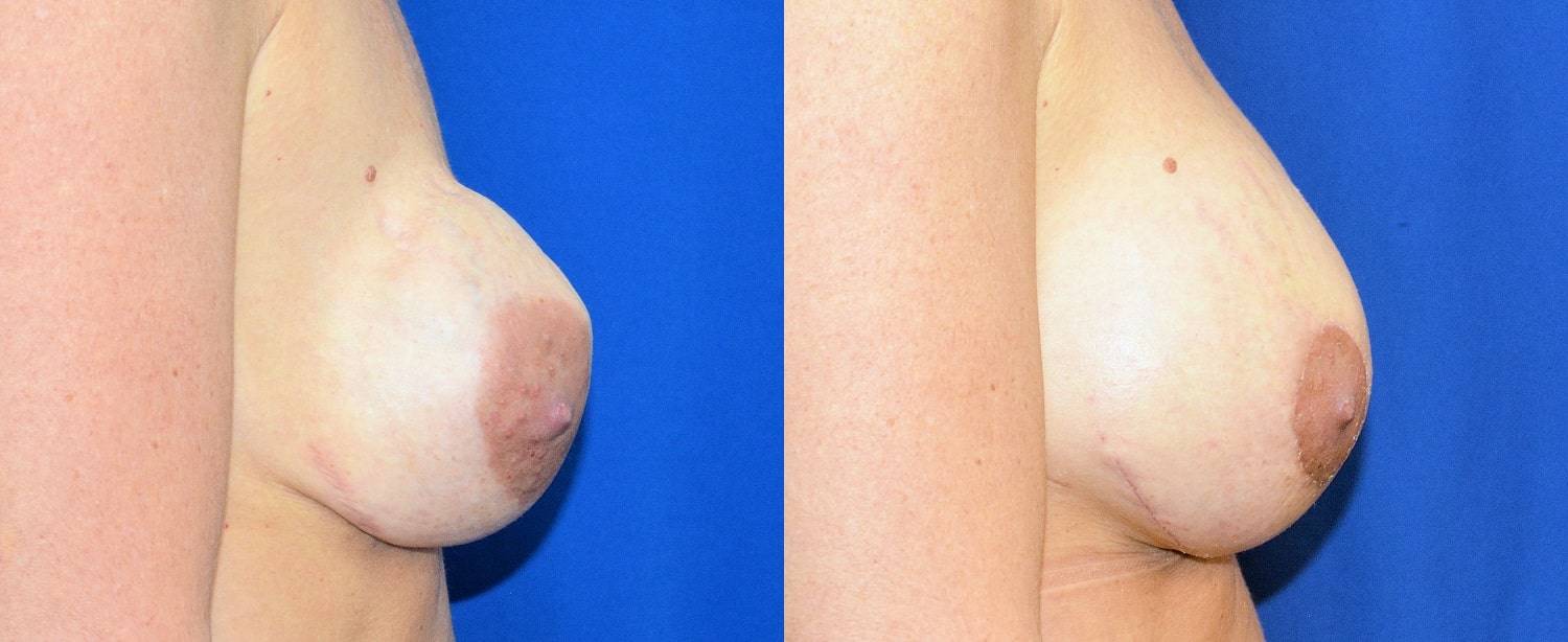04-re-do-breast-surgery-dr-marc-wetherington-rome-ga