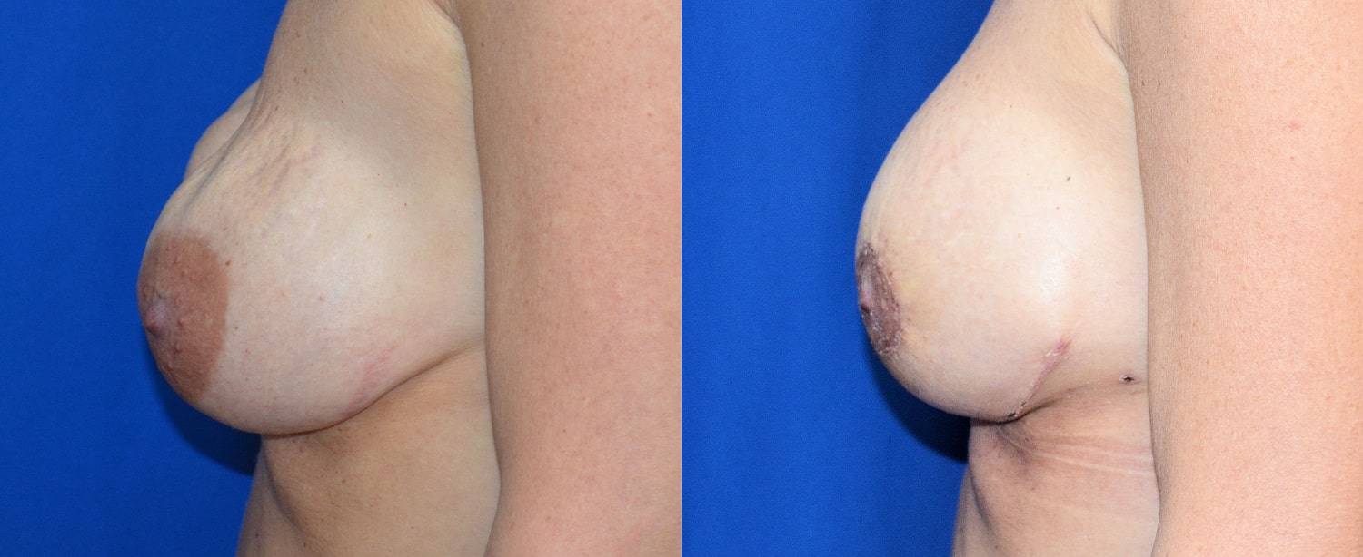 05-re-do-breast-surgery-dr-marc-wetherington-rome-ga