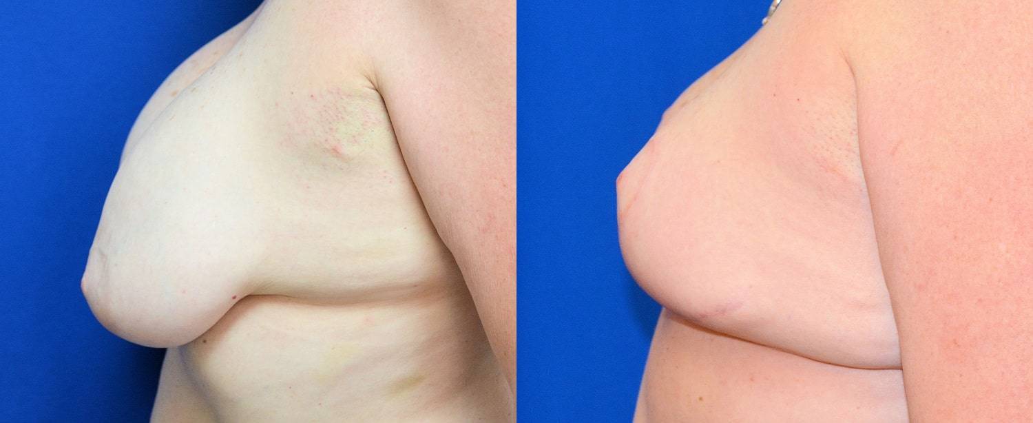 06-re-do-breast-surgery-dr-marc-wetherington-rome-ga