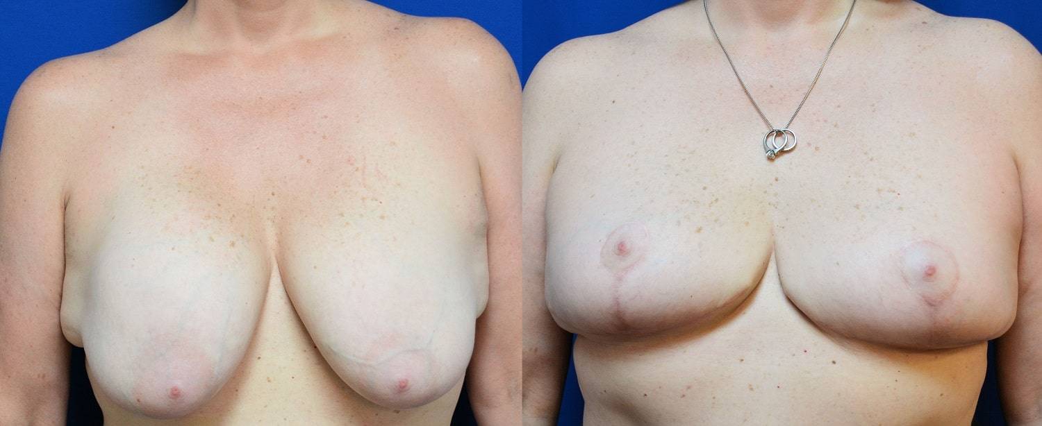 07-re-do-breast-surgery-dr-marc-wetherington-rome-ga