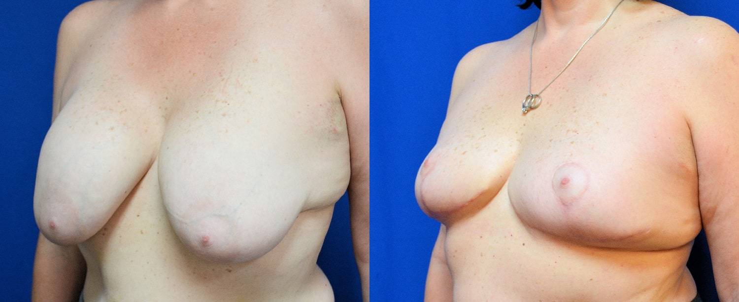 09-re-do-breast-surgery-dr-marc-wetherington-rome-ga