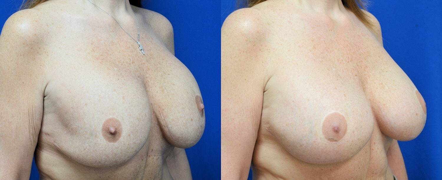 13-re-do-breast-surgery-dr-marc-wetherington-rome-ga