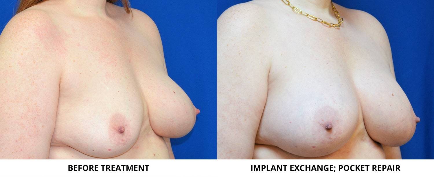 14-re-breast-revision-surgery-dr-marc-wetherington-rome-ga