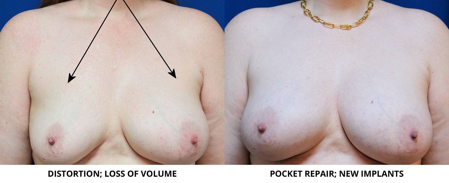 16-re-breast-revision-surgery-dr-marc-wetherington-rome-ga