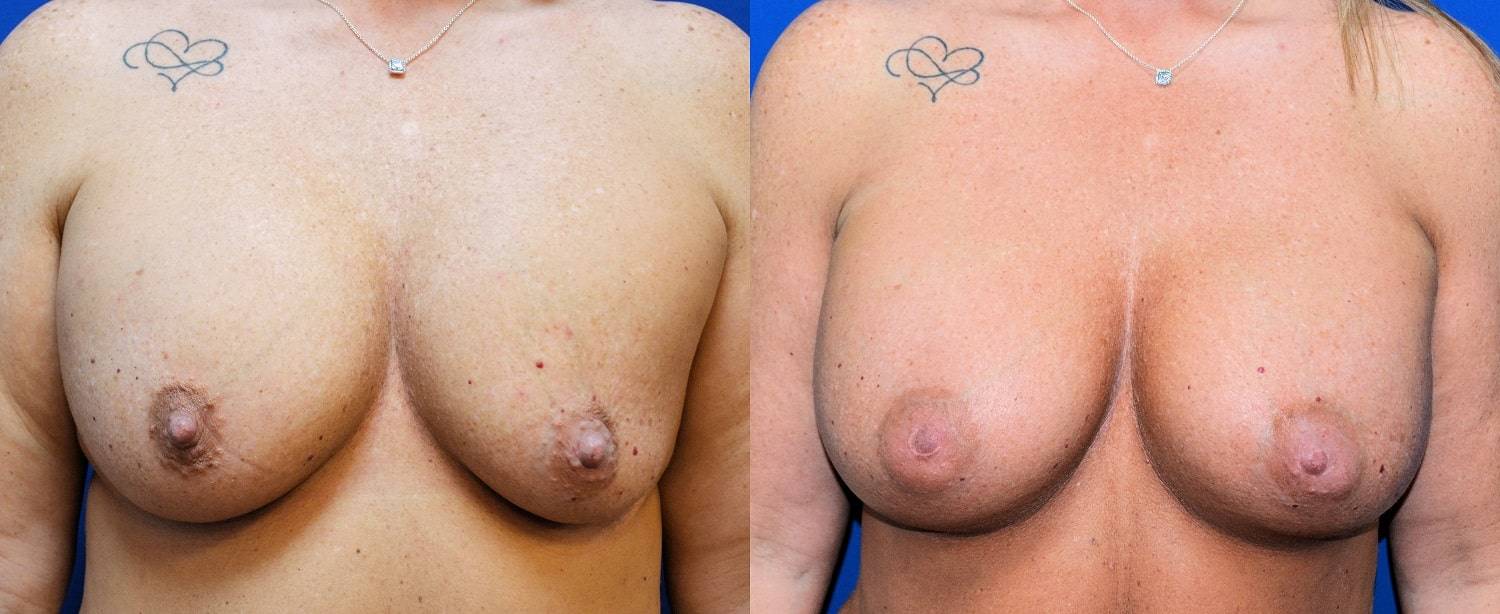 17-re-breast-revision-surgery-dr-marc-wetherington-rome-ga