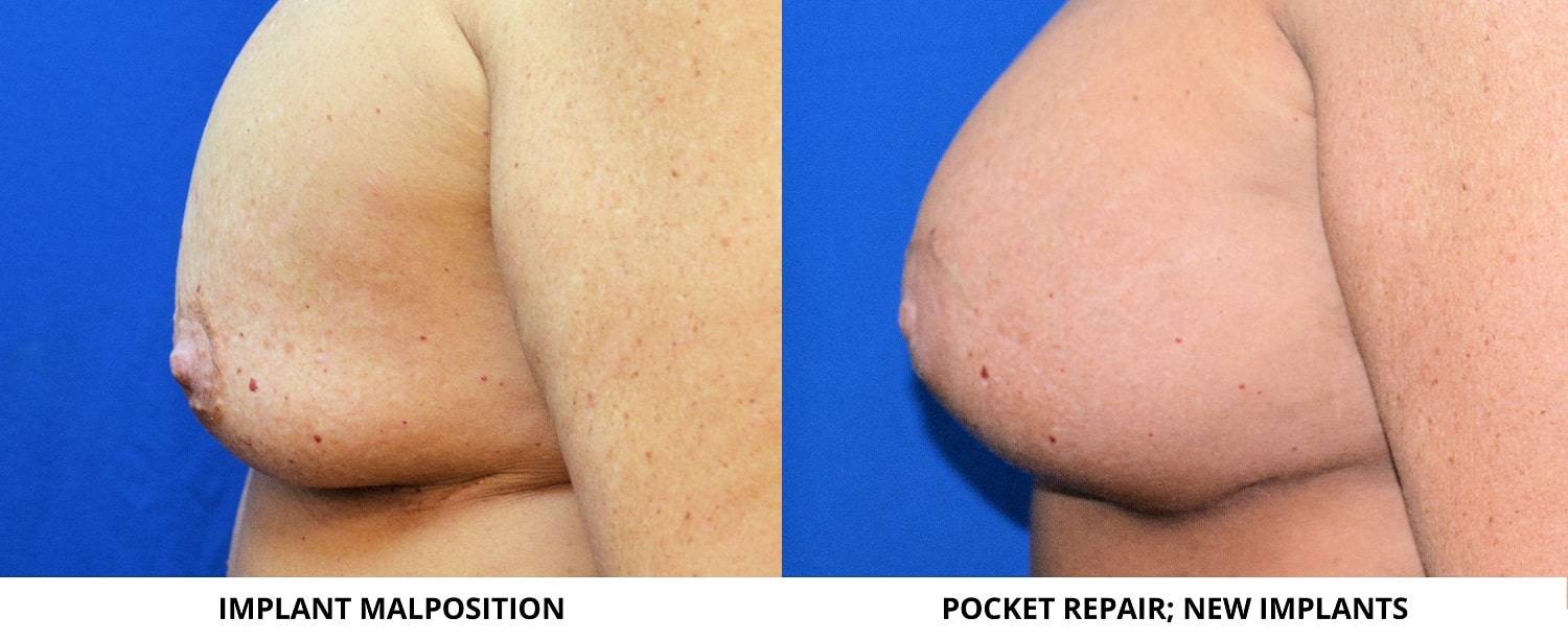 18-re-breast-revision-surgery-dr-marc-wetherington-rome-ga