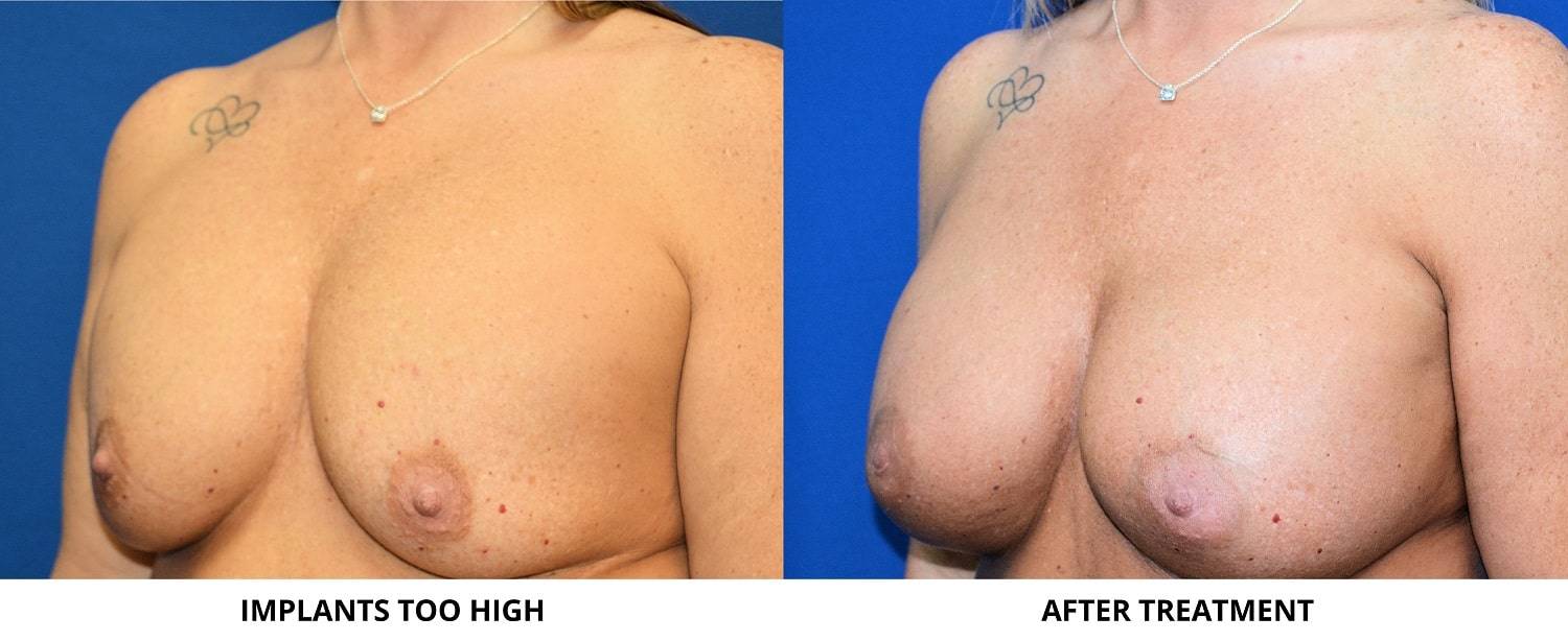 19-re-breast-revision-surgery-dr-marc-wetherington-rome-ga