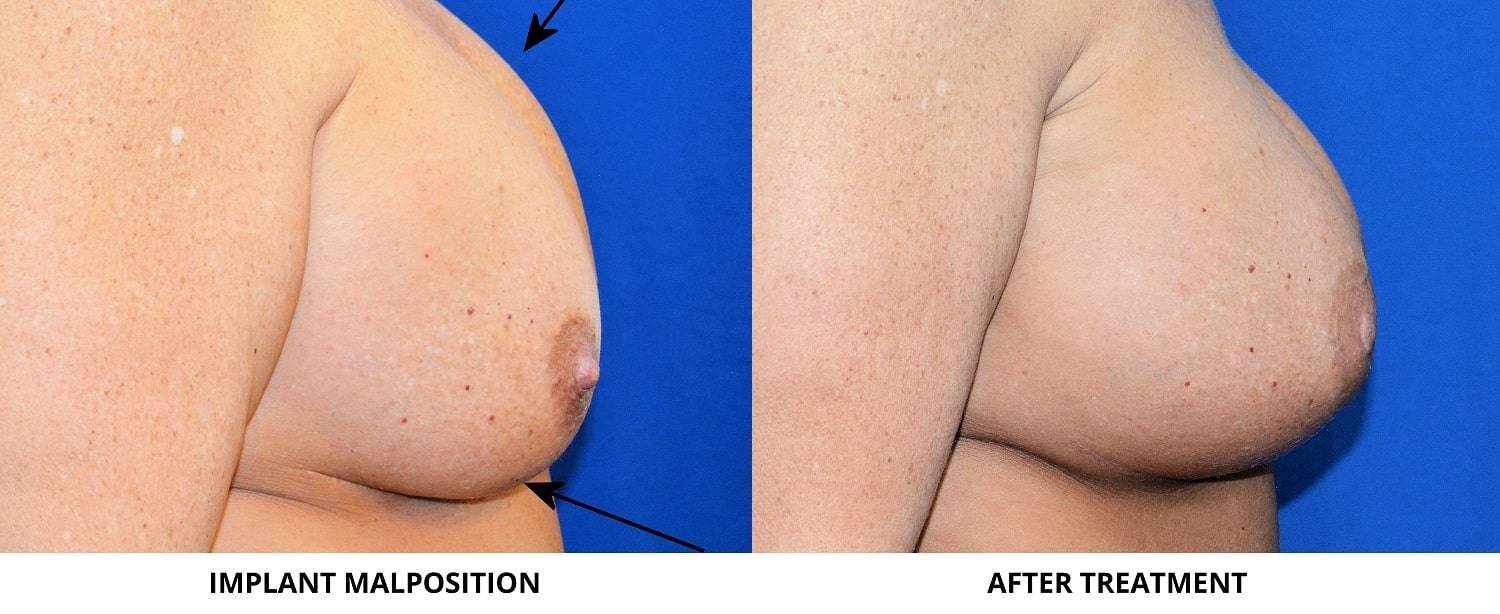 21-re-breast-revision-surgery-dr-marc-wetherington-rome-ga