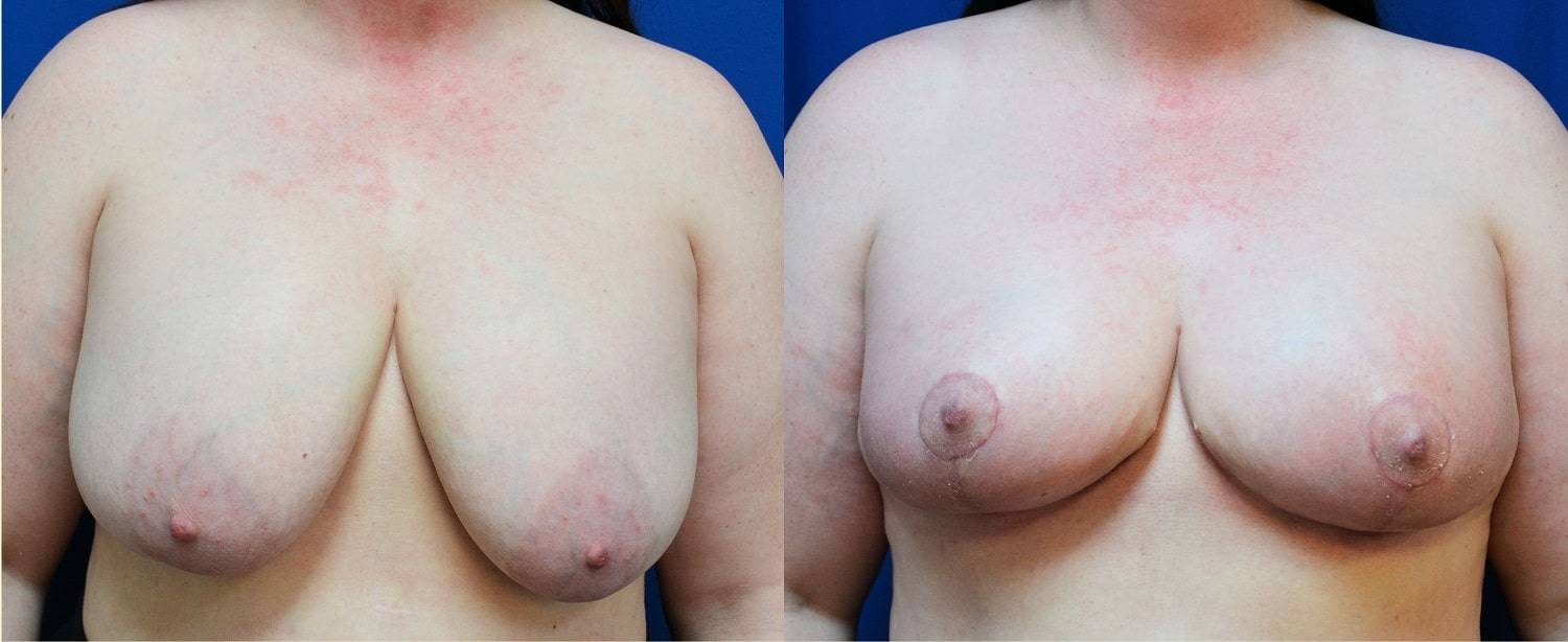 22-re-breast-revision-surgery-dr-marc-wetherington-rome-ga
