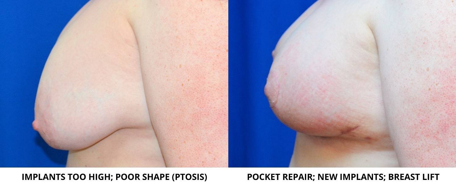 23-re-breast-revision-surgery-dr-marc-wetherington-rome-ga