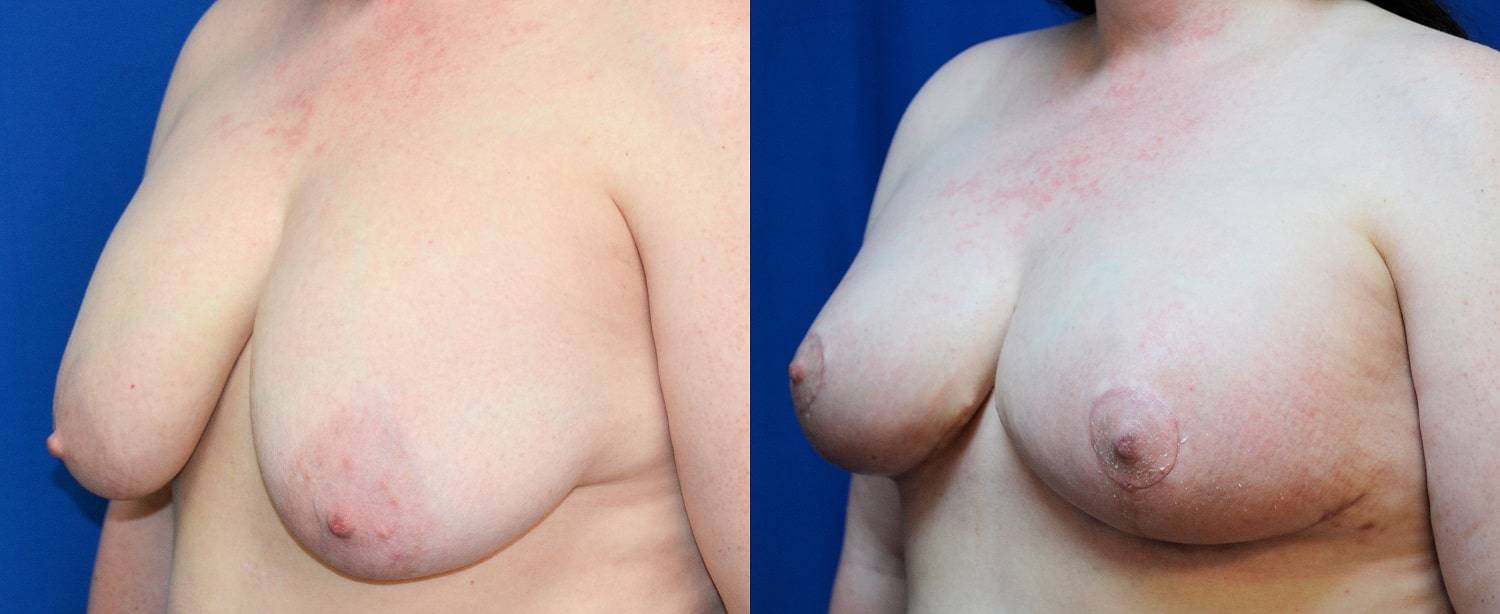 24-re-breast-revision-surgery-dr-marc-wetherington-rome-ga