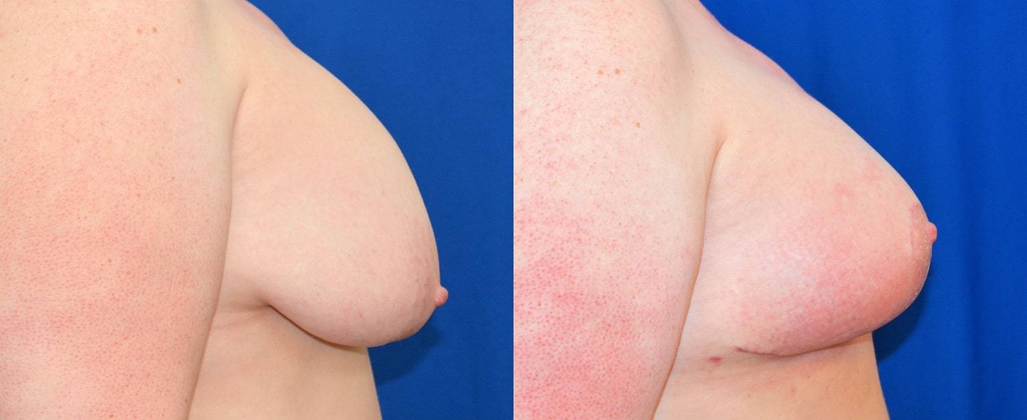25-re-breast-revision-surgery-dr-marc-wetherington-rome-ga