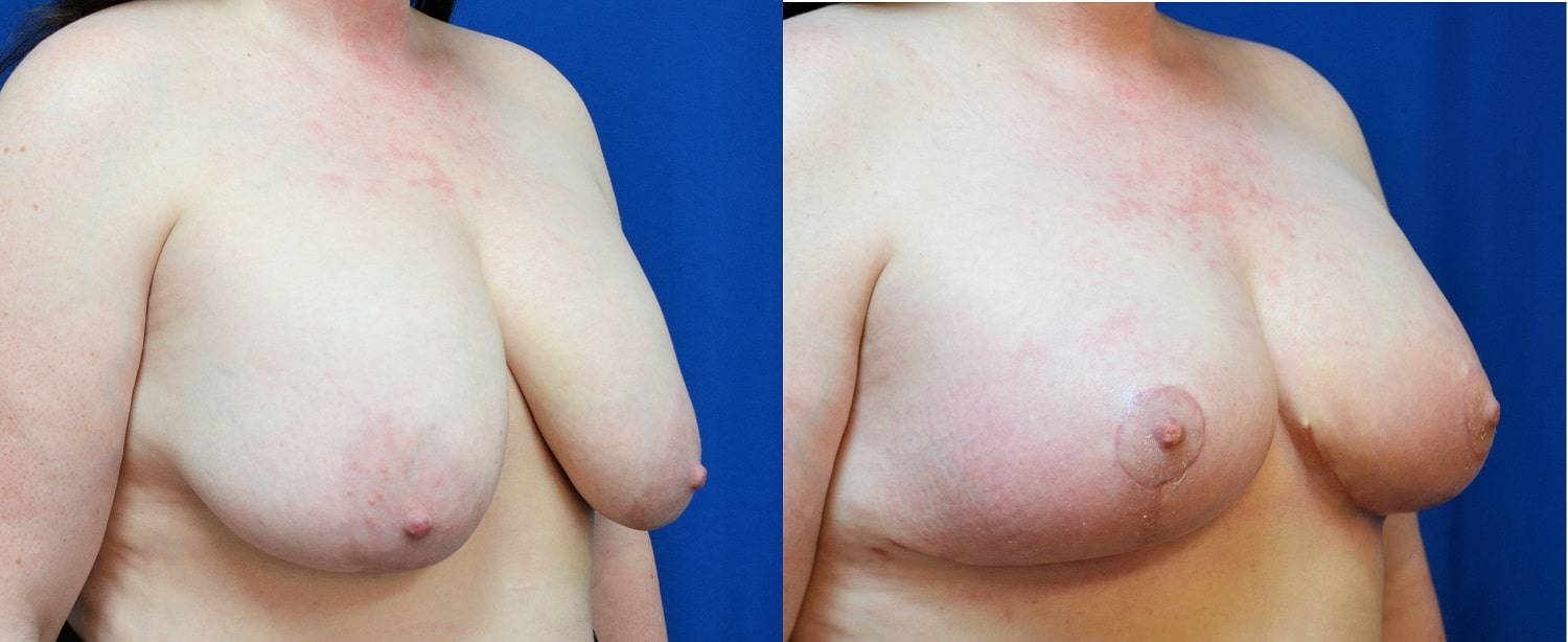 26-re-breast-revision-surgery-dr-marc-wetherington-rome-ga