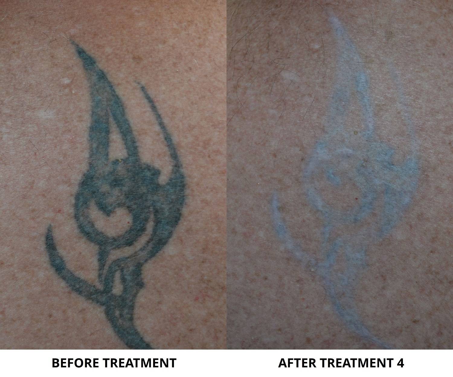 dr-marc-wetherington-tattoo-removal-rome-ga-04
