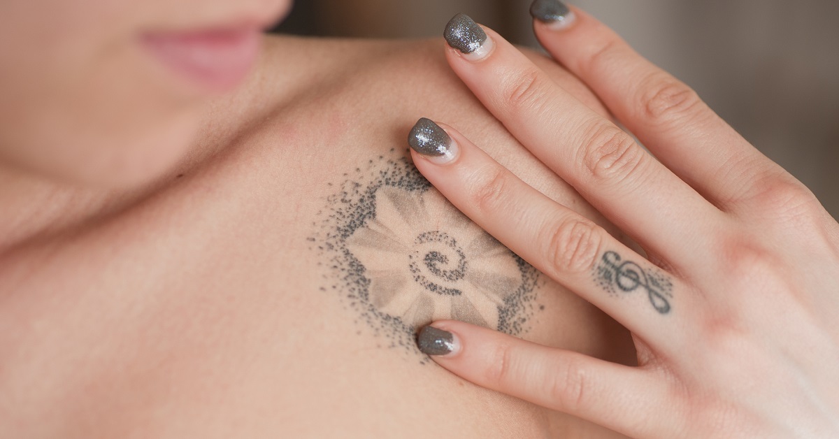 Is it Time to Get Rid of That Tattoo?