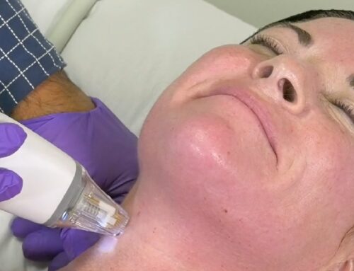 All You Need to Know About Radiofrequency Microneedling
