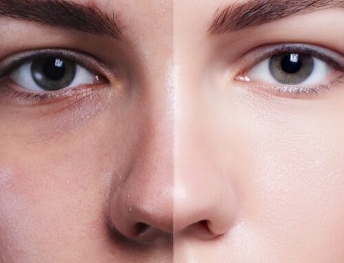 The Benefits of Laser Facial Rejuvenation