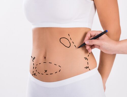 Liposuction: Is it Right for You?